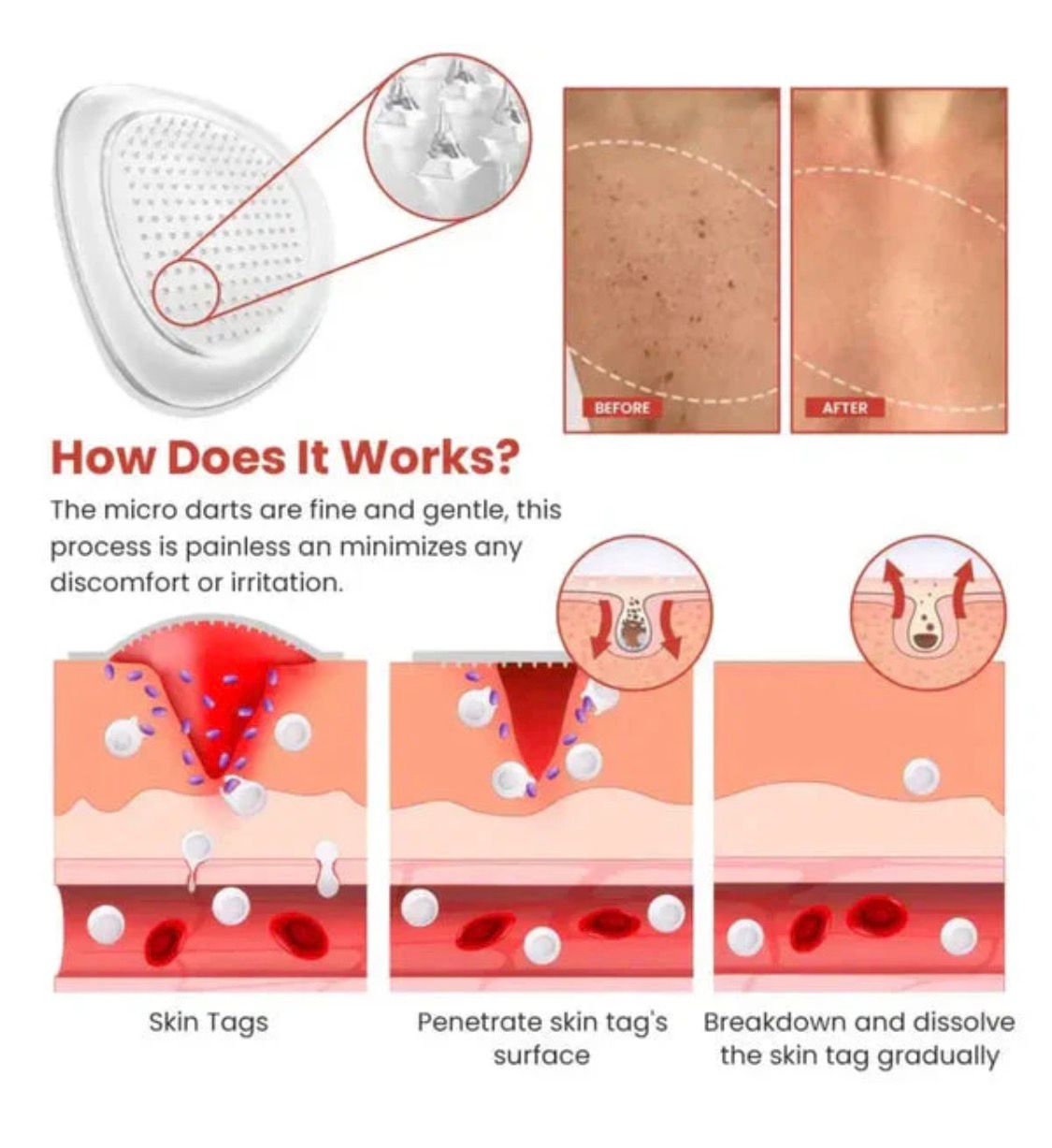 Derma Smooth Skin Tag Removal Patch - 72 Patches